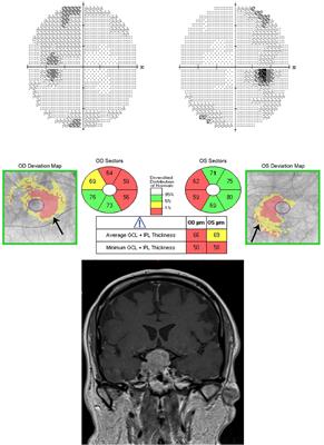 Sellar masses: diagnosis and treatment